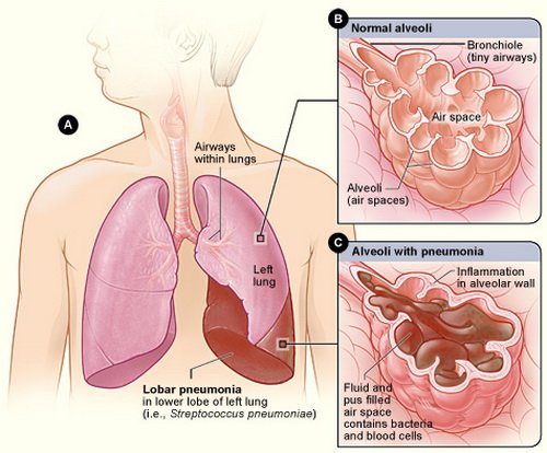 Adakah radang paru-paru atau pneumonia menular?