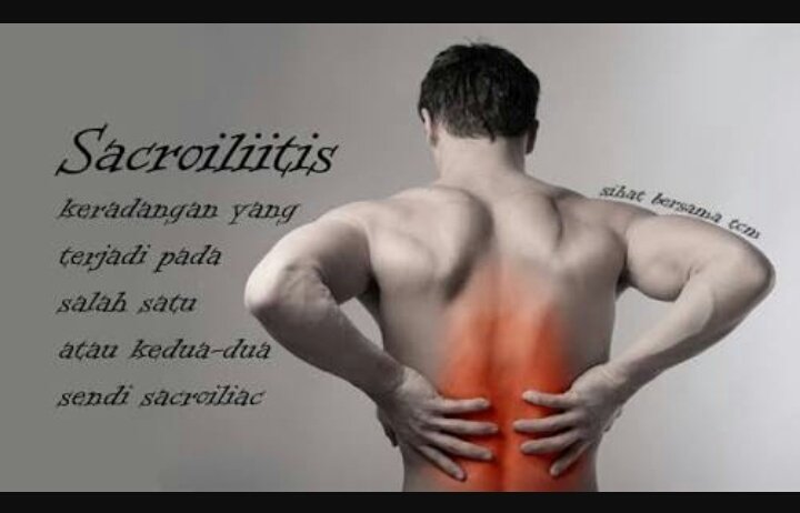 Apa itu sacroiliitis sakit belakang?