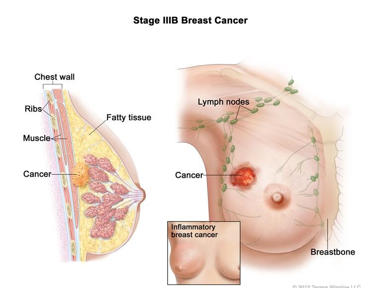 Apa yang perlu diketahui mengenai kanser payudara dan 