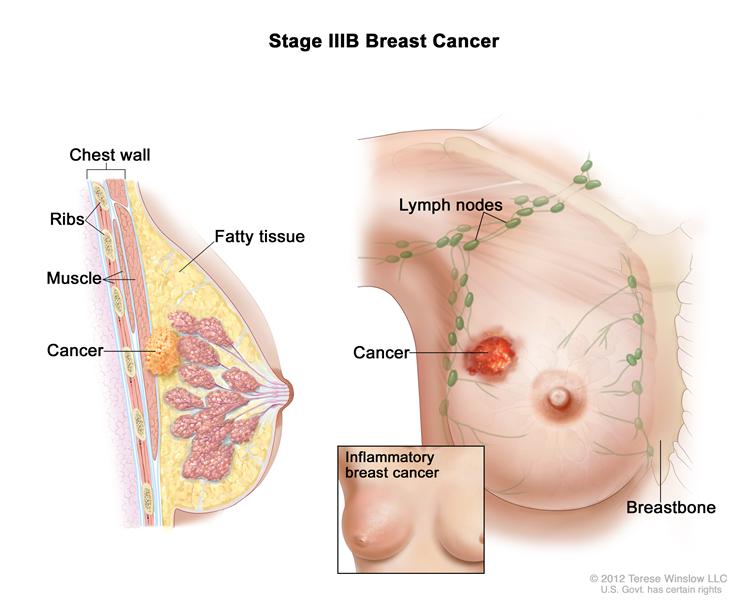 Apa yang perlu diketahui mengenai kanser payudara dan sakit belakang