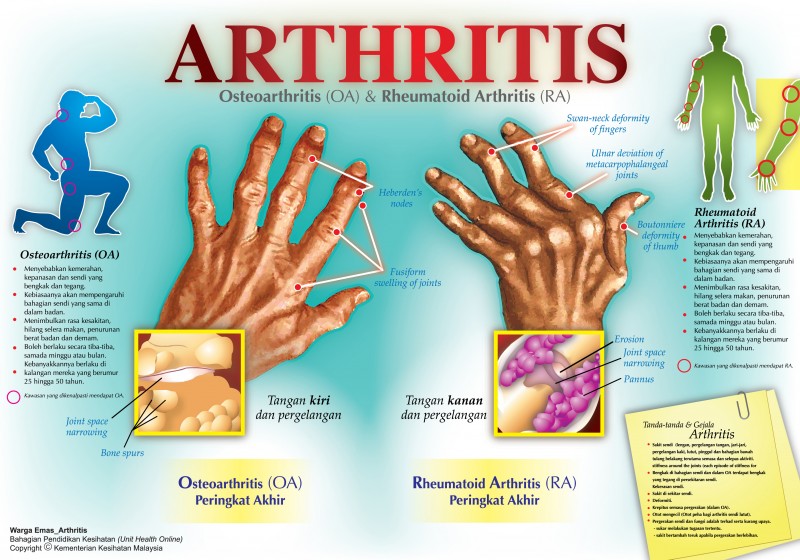 Bagaimanakah arthritis memberi kesan kepada mata?