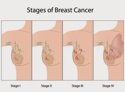 Mekanisme utama untuk pencegahan kanser payudara yang agresif dijumpai