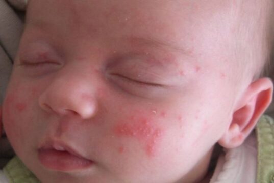 Bayi dengan cacar air menyebabkan bintik-bintik di seluruh tubuh mereka dipegang oleh ibu.