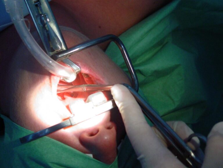 Tonsillectomy: Prosedur dan pemulihan