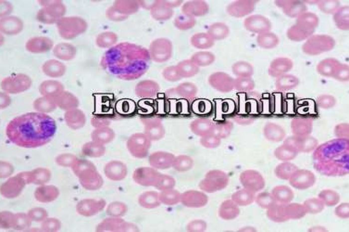 Eosinofil dan apakah yang perlu diketahui mengenainya?