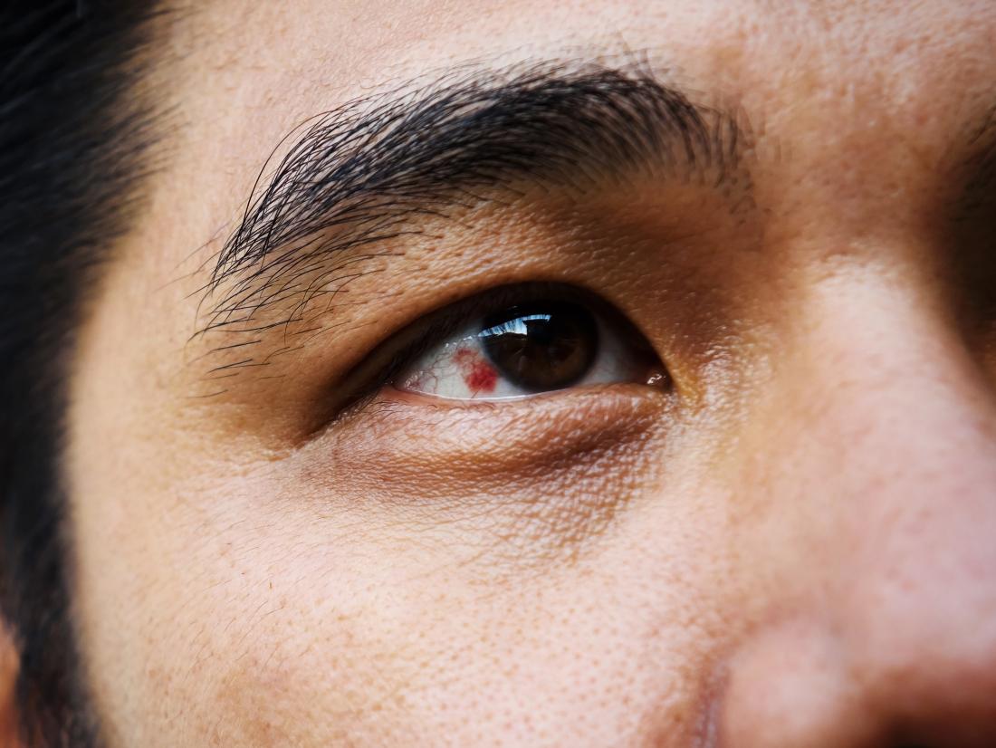 pendarahan subconjunctival di mata kanan lelaki