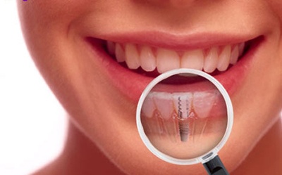 Implan gigi apa yang perlu diketahui mengenainya ⋆ Sihat.Net