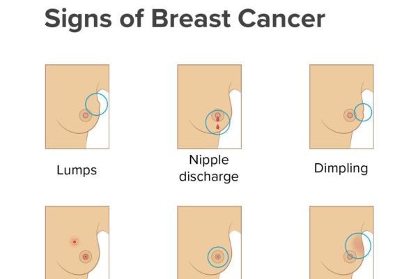 tanda-tanda barah payudara