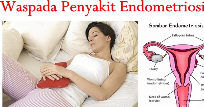 Endometriosis – Rawatan alternatif dan semula jadi