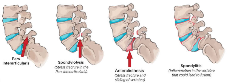 Anterolisthesis: Gejala, sebab, dan rawatan tulang belakang