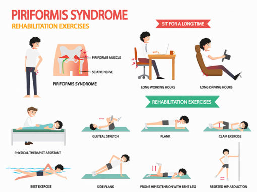 Sindrom Piriformis: Gejala, diagnosis, dan rawatan