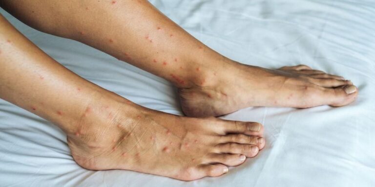 Apa yang boleh menyebabkan bintik merah di kaki?