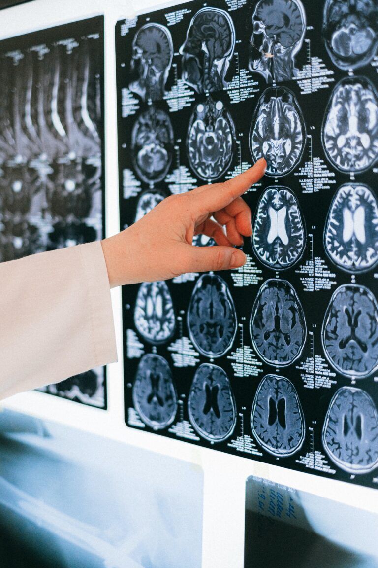 Otak bengkak: Gambaran Keseluruhan Punca dan Rawatan “Cerebral Edema”